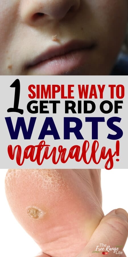 1 Simple way to get rid of warts naturally