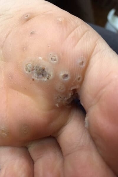 get rid of warts naturally on feet
